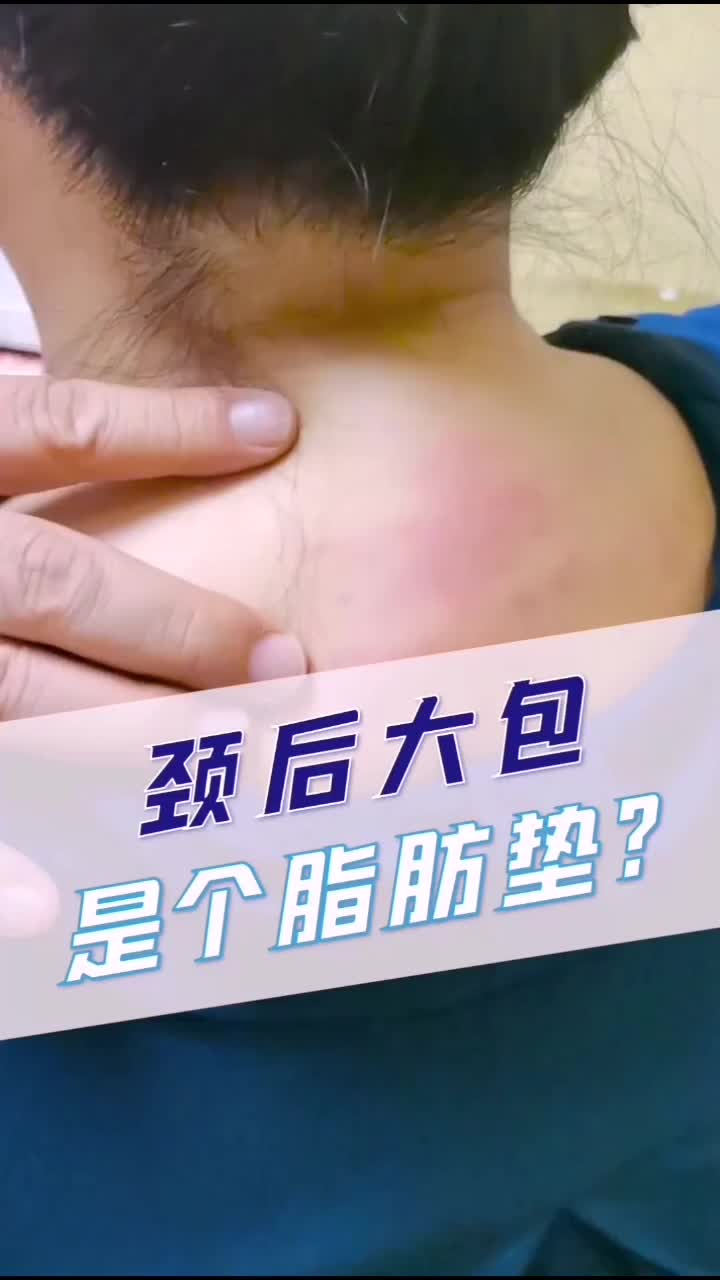 富贵包 不可怕,多数是#颈椎 问题引起的.