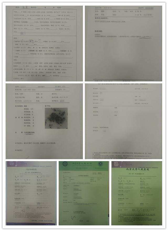 高危HPV，宫颈湿疣样病变，宫颈病变CINⅡ级