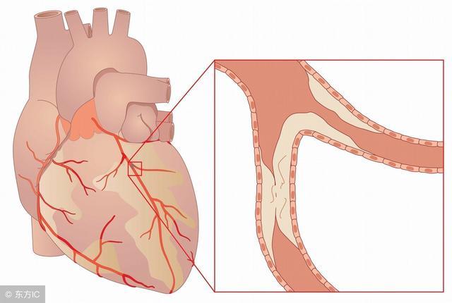 心肌缺血最简单自测法（女性心肌缺血的原因）