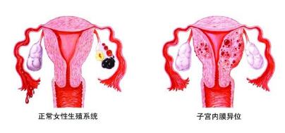 精细化,最大限度地避免损伤健康的内膜组织,保留宫腔的正常形态,为