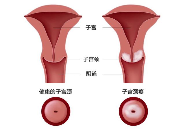 宫颈病变？宫颈癌变？病变到底是不是癌变？