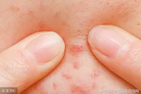为什么脸上老是长痘?看看是不是做错了这6件事