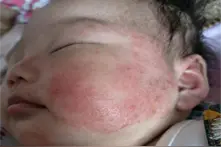 一擦就好?别被骗了!湿疹膏这样选、这样用才靠谱!