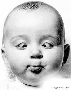 大脑发出的预警信号——对眼儿_小儿斜视_小儿斜视 - 好大夫在线