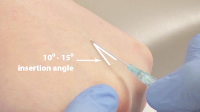 静脉留置针操作流程(静脉留置针穿刺流程图)