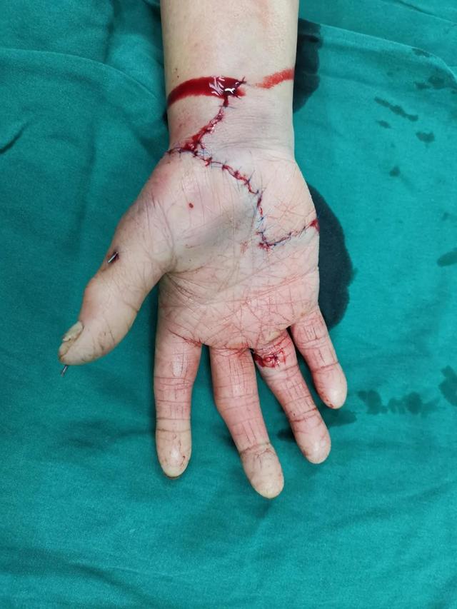 树兰杭州医院医生奋战 5 小时，断掌残垣成功再植