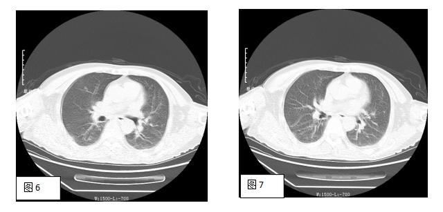 做 CT 时憋没憋气能看出来吗？