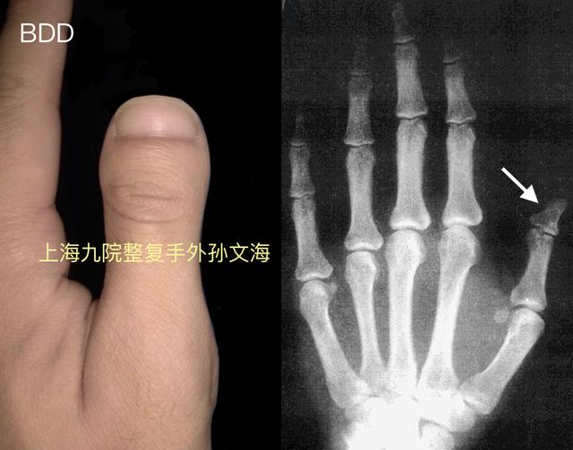 什么是短指症 先天性骨与关节畸形 先天性骨与关节畸形