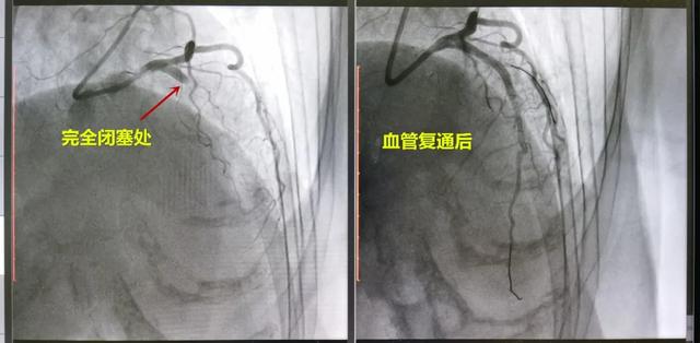 突发心梗，一半心肌缺血，树兰胸痛中心紧急介入