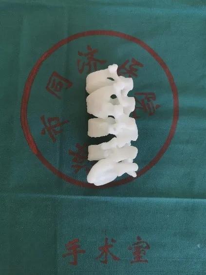 同济大学附属同济医院成功救治一例复杂儿童腰椎半椎体畸形