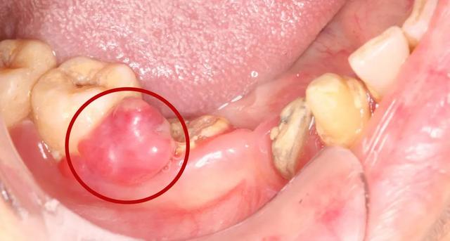 牙龈瘤并不是真的肿瘤，口腔清洁是关键