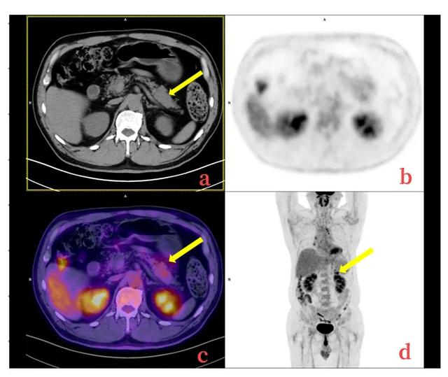 肿瘤标志物异常升高原因不明，看 PET/MR 如何鉴别