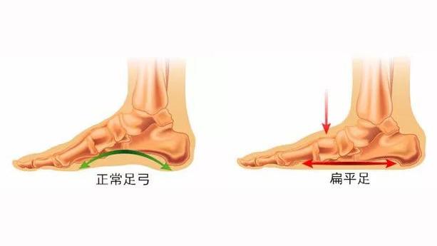 扁平足的危害有哪些 又该怎么治疗呢 可以预防吗 扁平足 扁平足