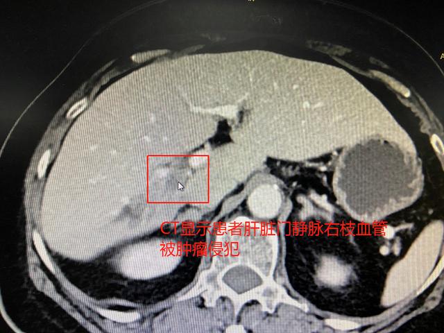 树兰（杭州）医院肝胆胰外科  成功完成一例腹腔镜右半肝切除术