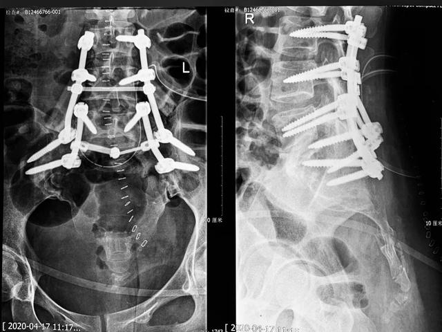 29 岁姑娘，骶骨所剩无几……