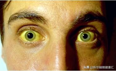 通常,血液的资料:小儿黄疸黄疸,是指皮肤发黄,眼睛发黄,小便色黄