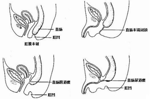 先天无肛门手术图解图片