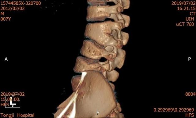 同濟大學附屬同濟醫院成功救治一例複雜兒童腰椎半椎體畸形
