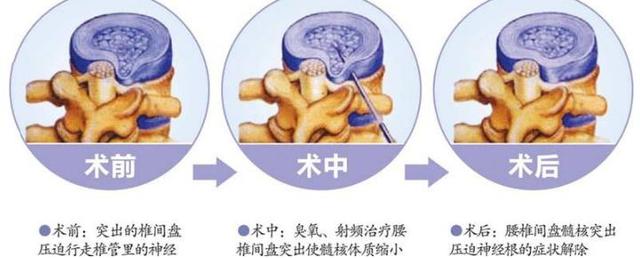 腰椎间盘突出微创介入治疗有哪些？ 中国医疗