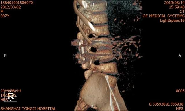 同济大学附属同济医院成功救治一例复杂儿童腰椎半椎体畸形