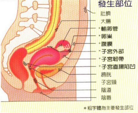 子宫腺肌症图解图片