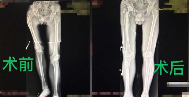 患者右腿比左腿短了7公分，全髋置换+截骨拼合手术如何展开？