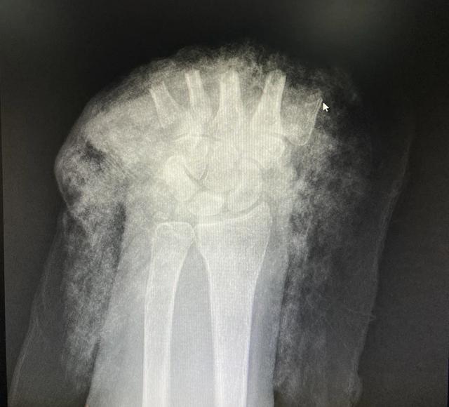 树兰杭州医院医生奋战 5 小时，断掌残垣成功再植