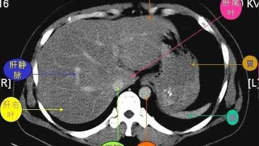 胃的CT解剖
